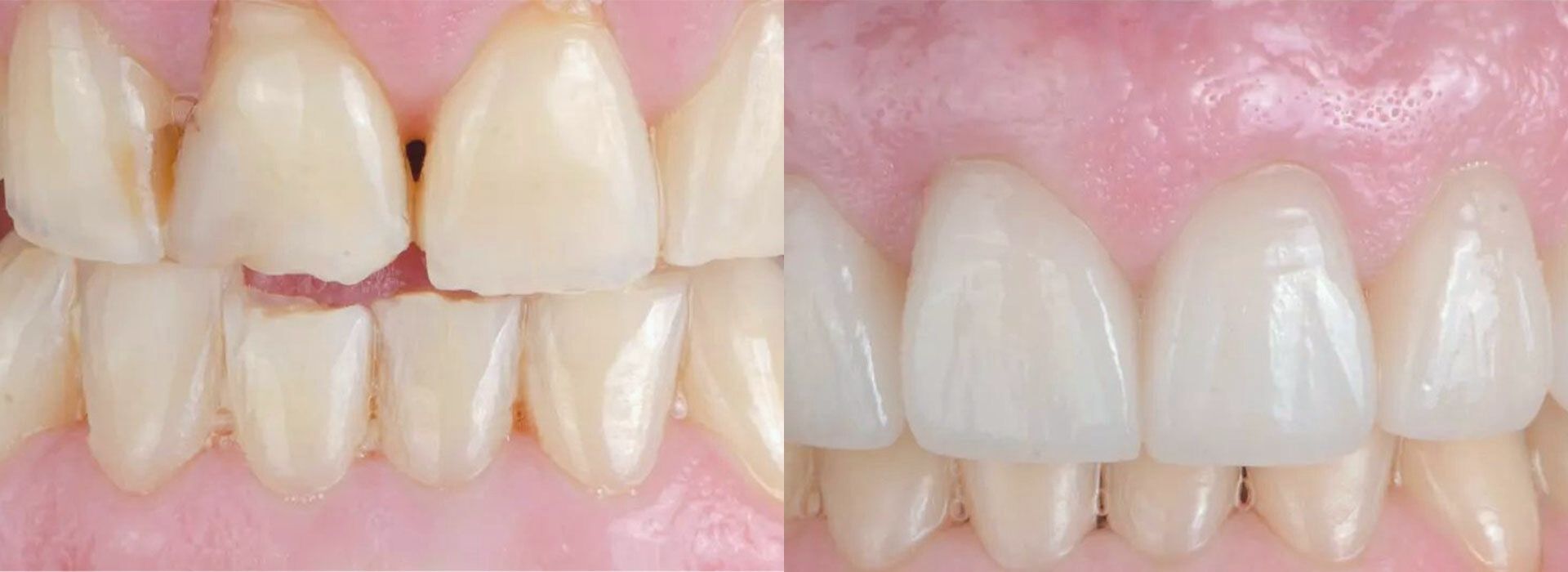 Direkte/indirekte Veneers und Zahnumformungen